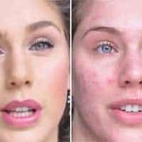 Acne en Model