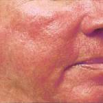 Acne Rosacea 1