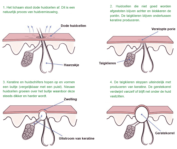 Hoe ontstaan milia gerstekorrels